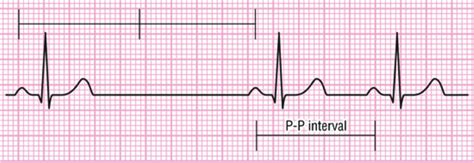 electrocardiograma con arritmia sinusal